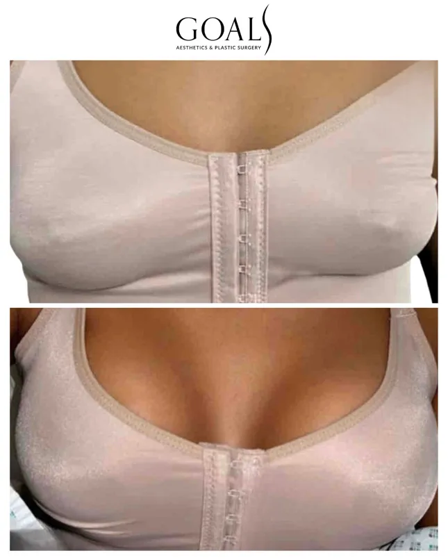 Before and after — Breast Augmentation, patient 5