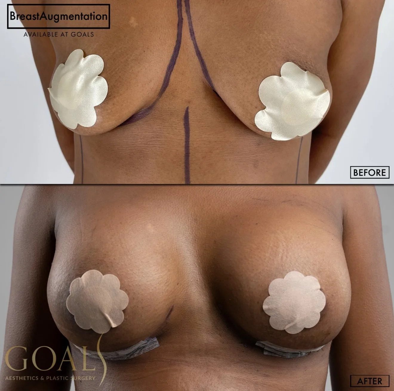 Before and after — Breast Augmentation, patient 6
