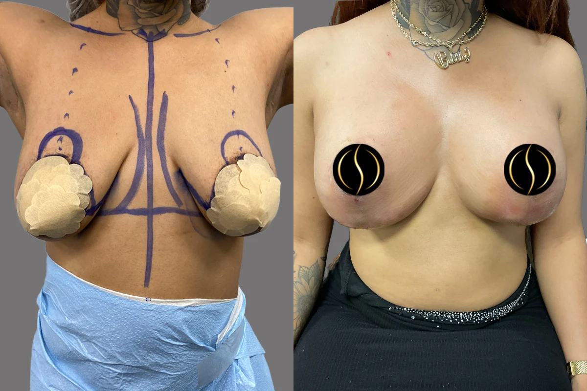 Before and after — Breast Augmentation, patient 5