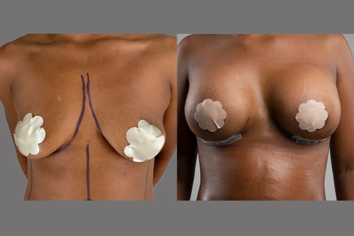 Before and after — Breast Augmentation, patient 6