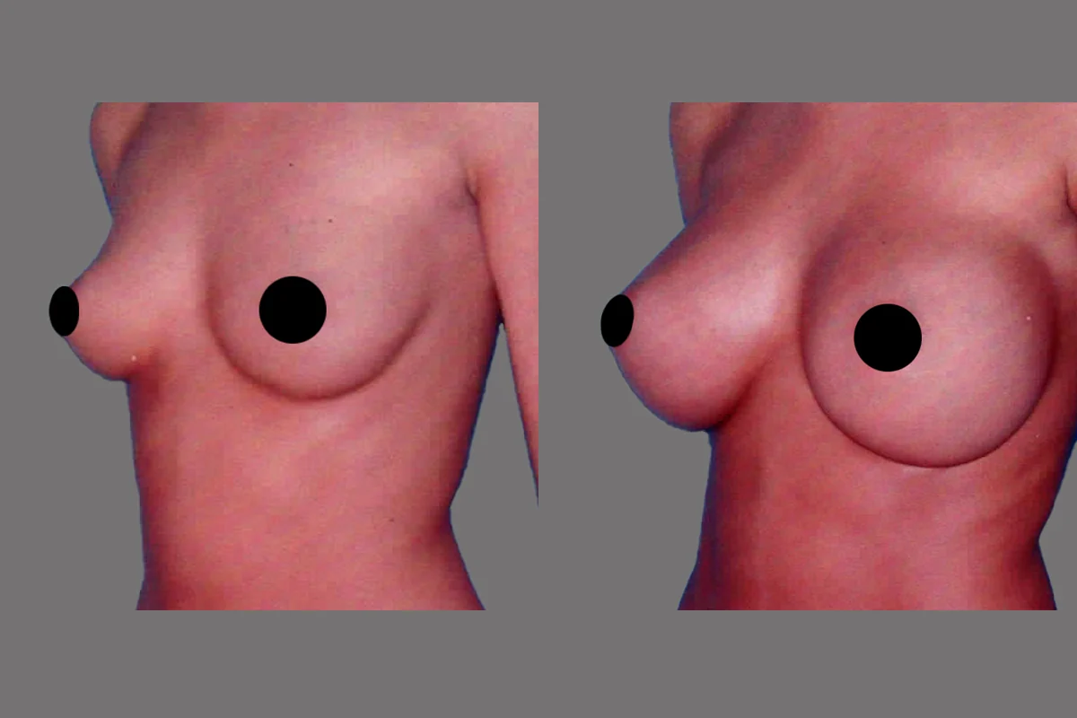 Before and after — Breast Augmentation · Atlanta Tucker Rd., patient 5