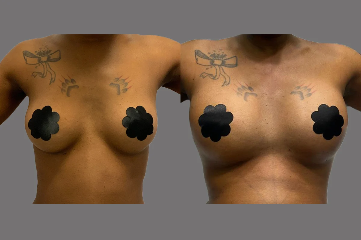 Before and after — Breast Augmentation · Atlanta Tucker Rd., patient 6
