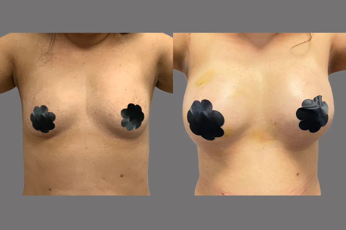Breast Augmentation — patient result