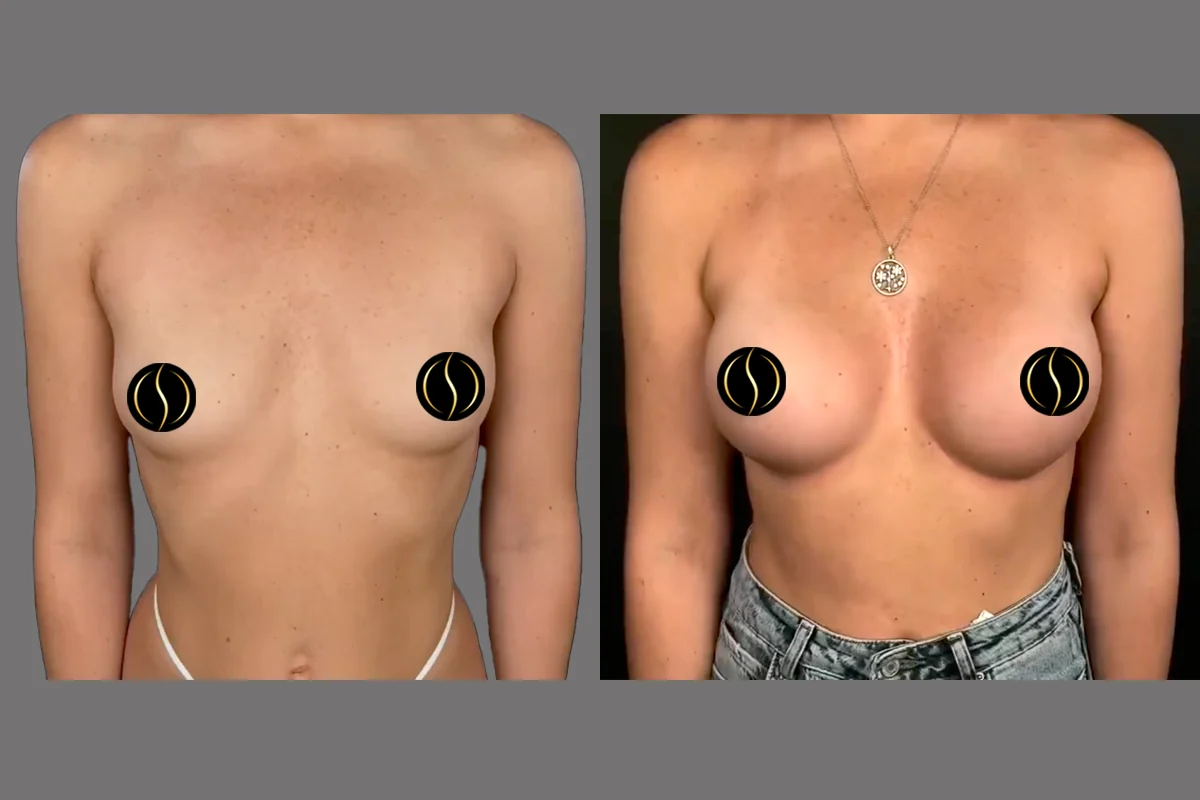 Before and after — Breast Augmentation, patient 1