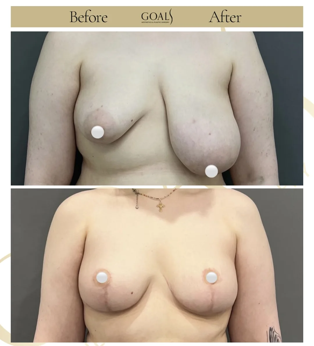 Before and after — Breast Lift, patient 2