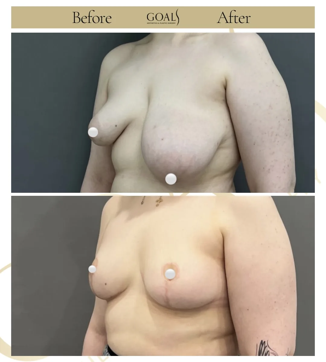 Before and after — Breast Lift, patient 3