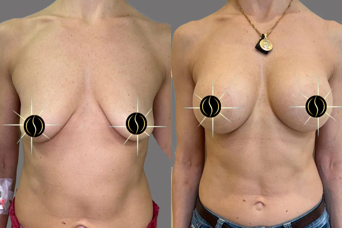 Before and after — Breast Lift, patient 4