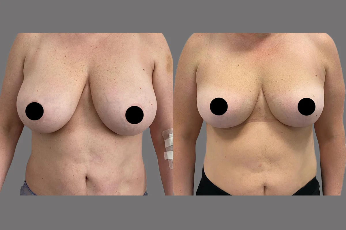 Before and after — Breast Lift, patient 6