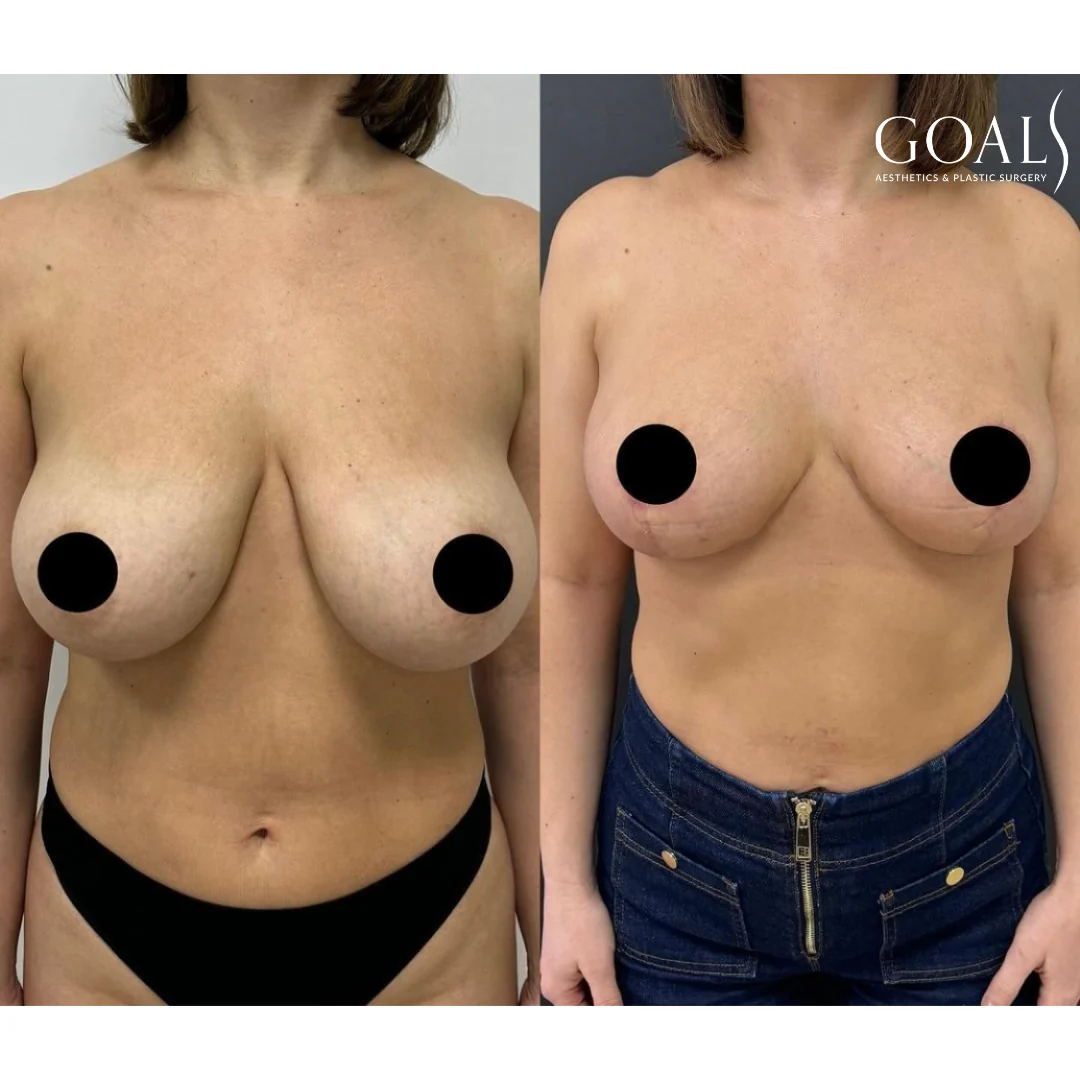 Before and after — Breast Reduction, patient 1