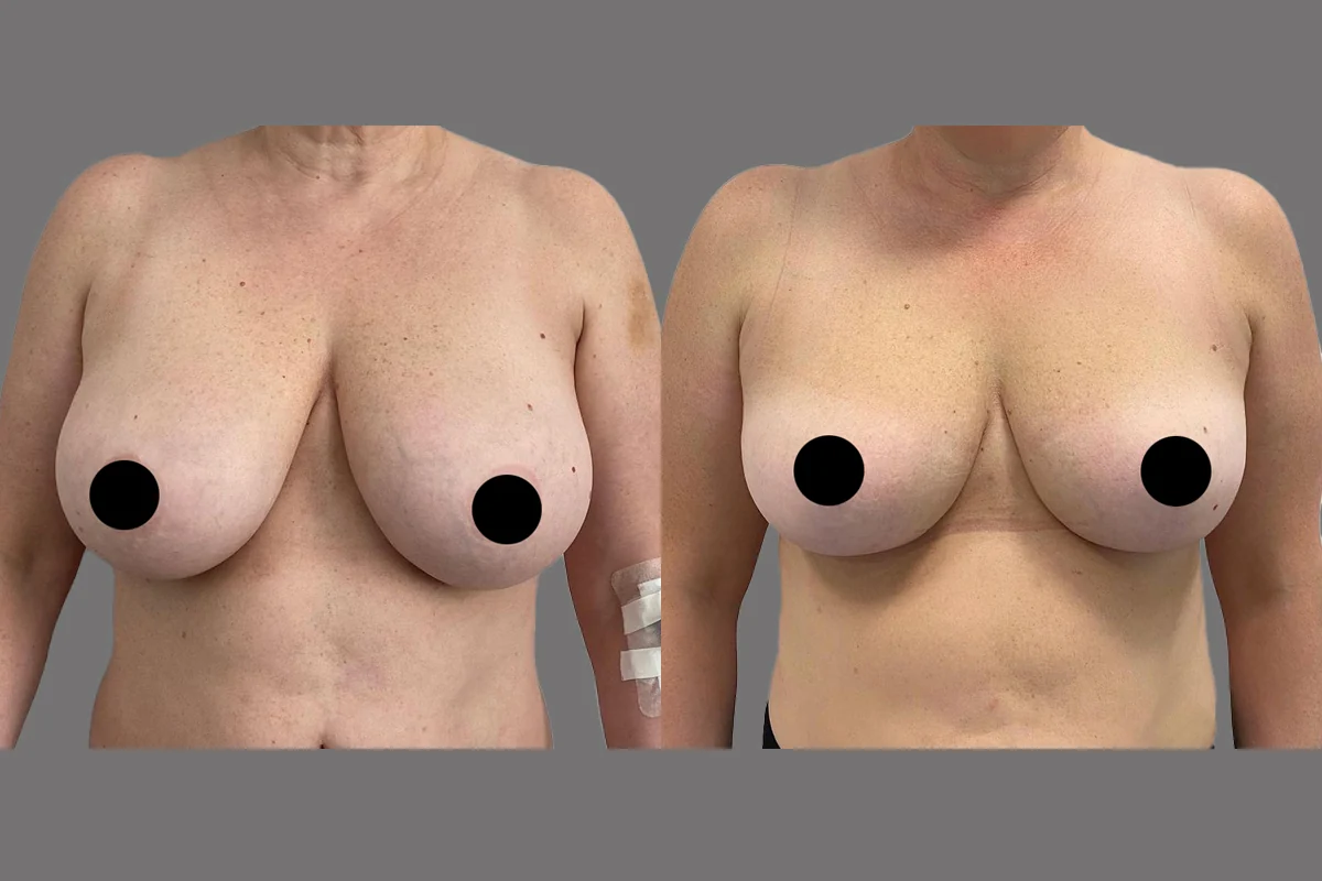 Before and after — Breast Reduction, patient 2