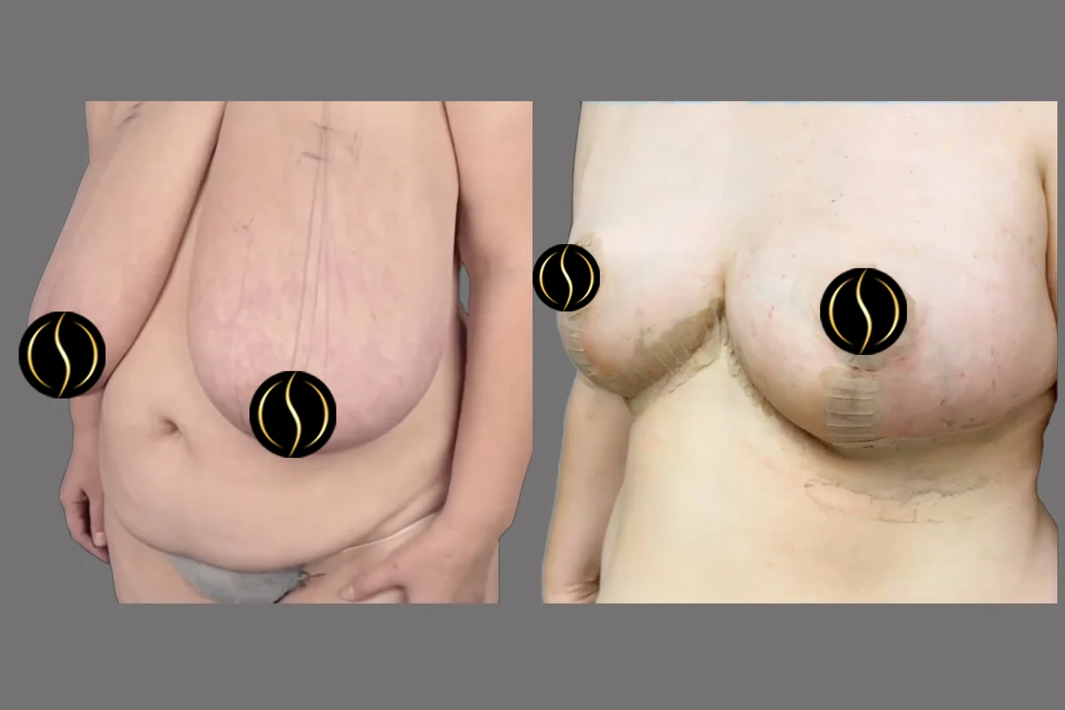 Before and after — Breast Reduction, patient 3