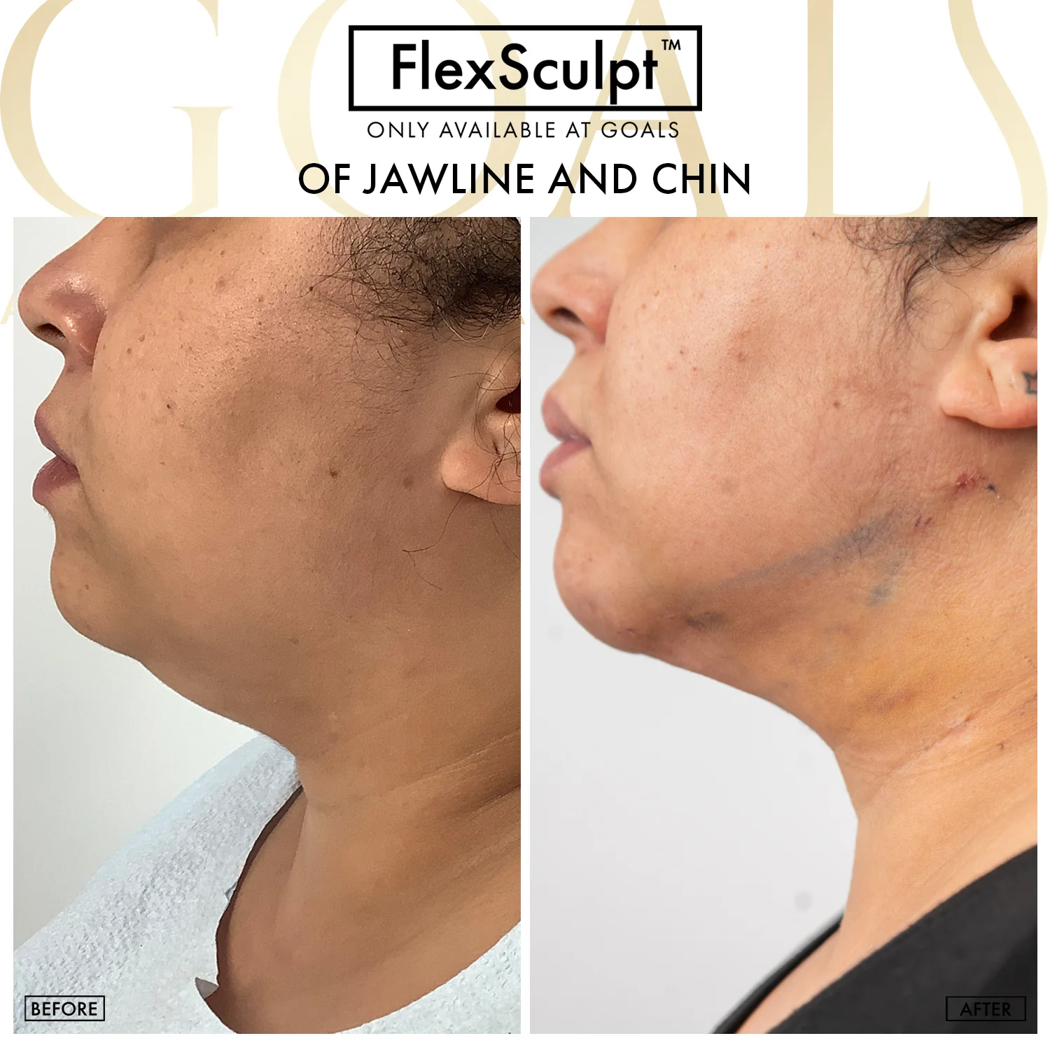 Before and after — Chin & Neck Contouring, patient 5