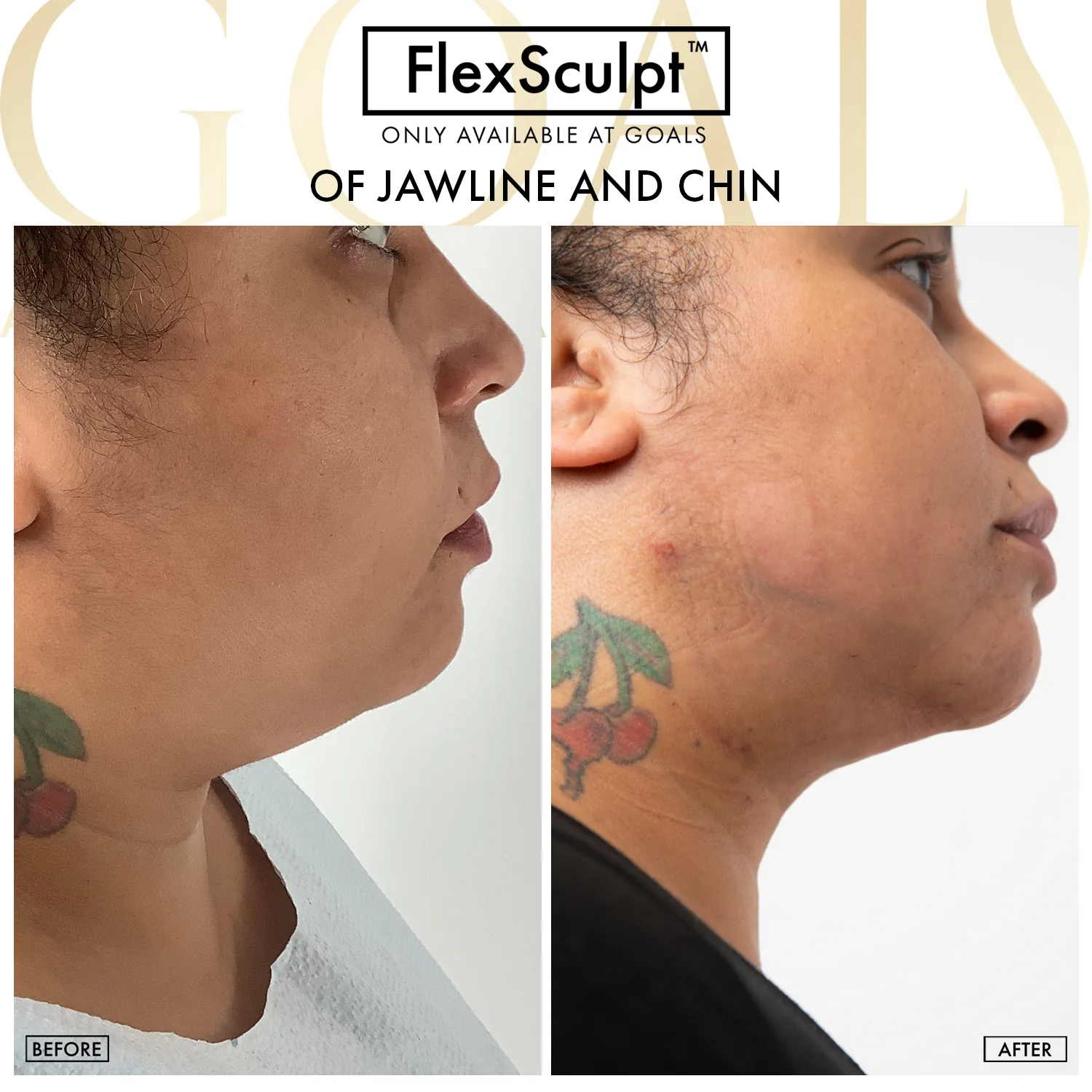 Before and after — Chin & Neck Contouring, patient 6