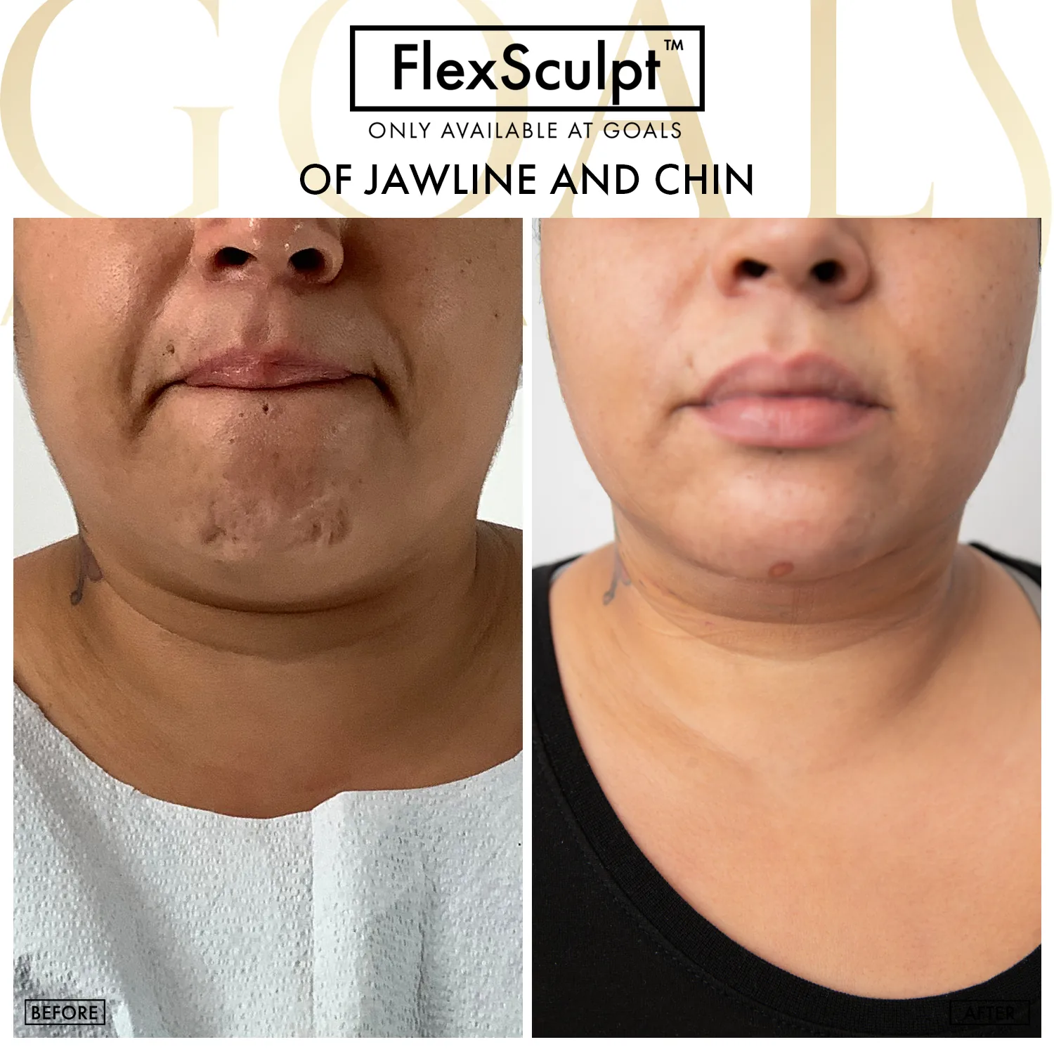 Before and after — Chin & Neck Contouring, patient 4