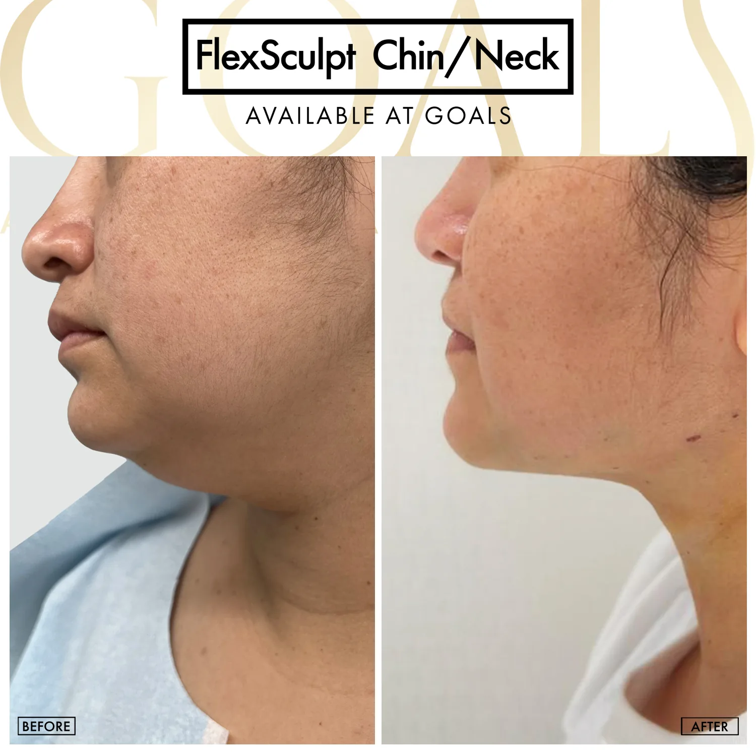 Before and after — Chin & Neck Contouring, patient 5