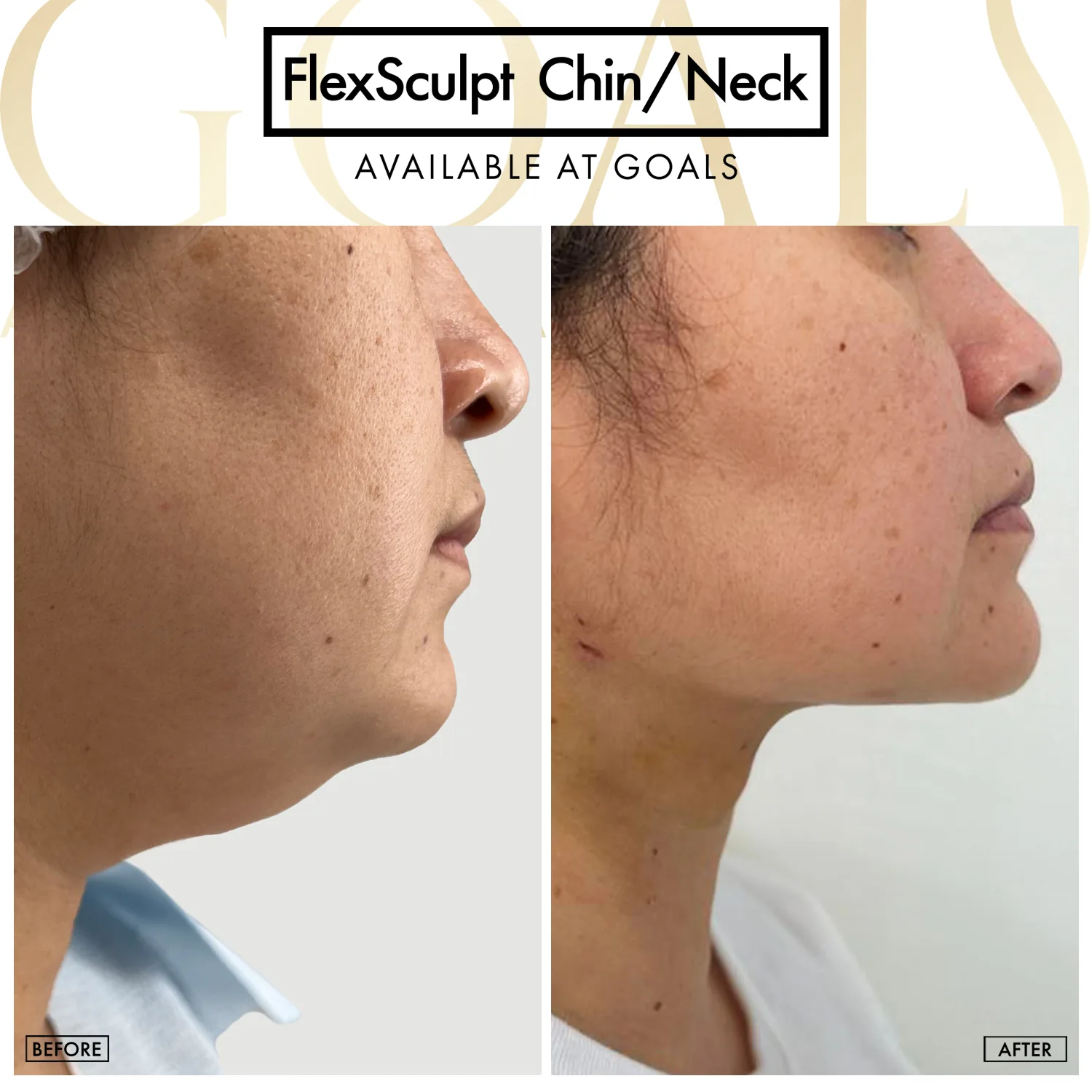 Before and after — Chin & Neck Contouring, patient 6