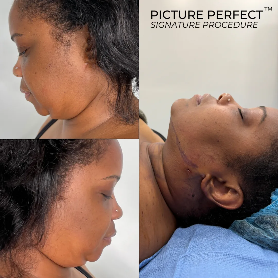 Before and after — Chin & Neck Contouring · Gaithersburg, patient 3