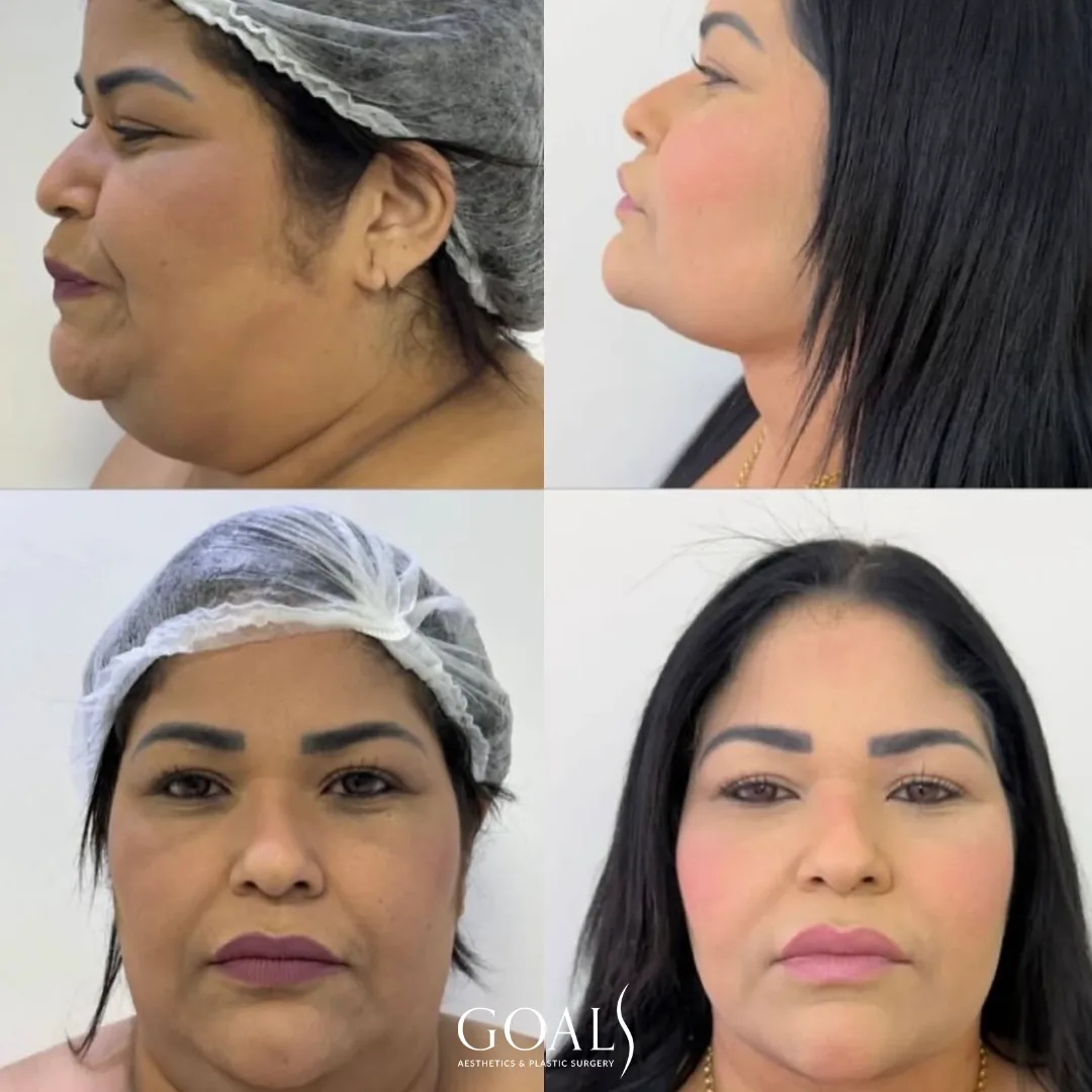 Before and after — Chin & Neck Contouring · Gaithersburg, patient 4