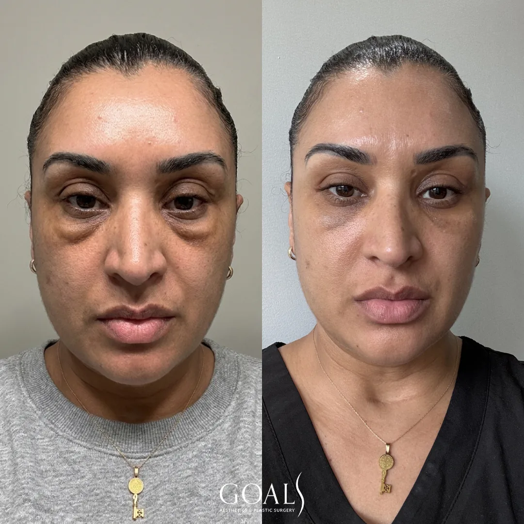 Before and after — Chin & Neck Contouring, patient 1