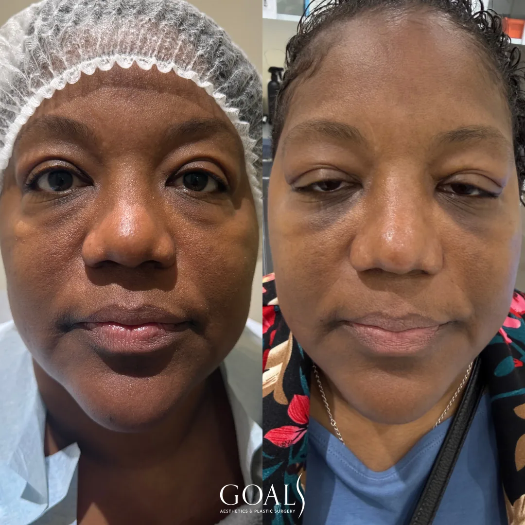 Before and after — Chin & Neck Contouring, patient 2