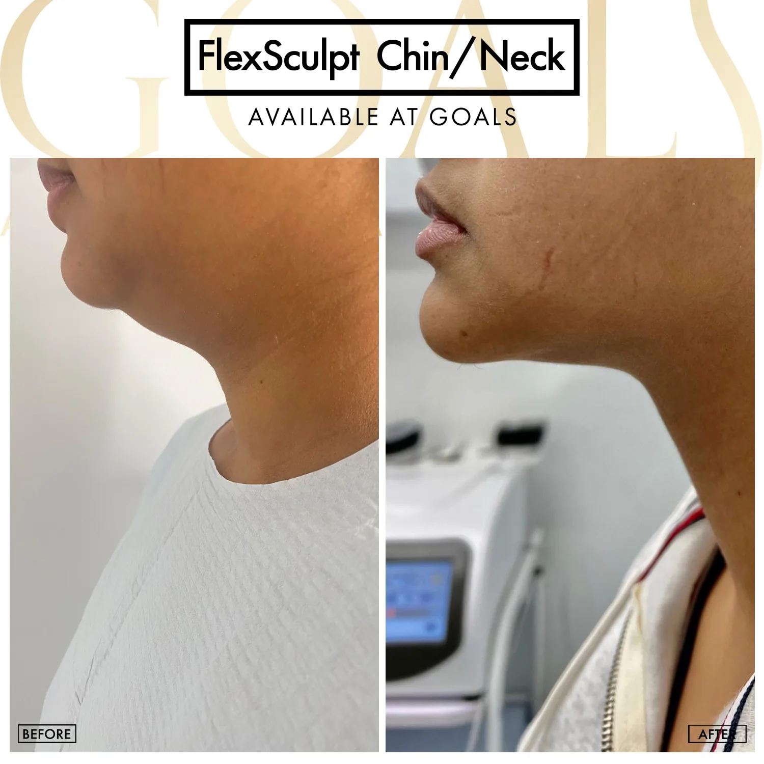 Before and after — Chin & Neck Contouring, patient 3