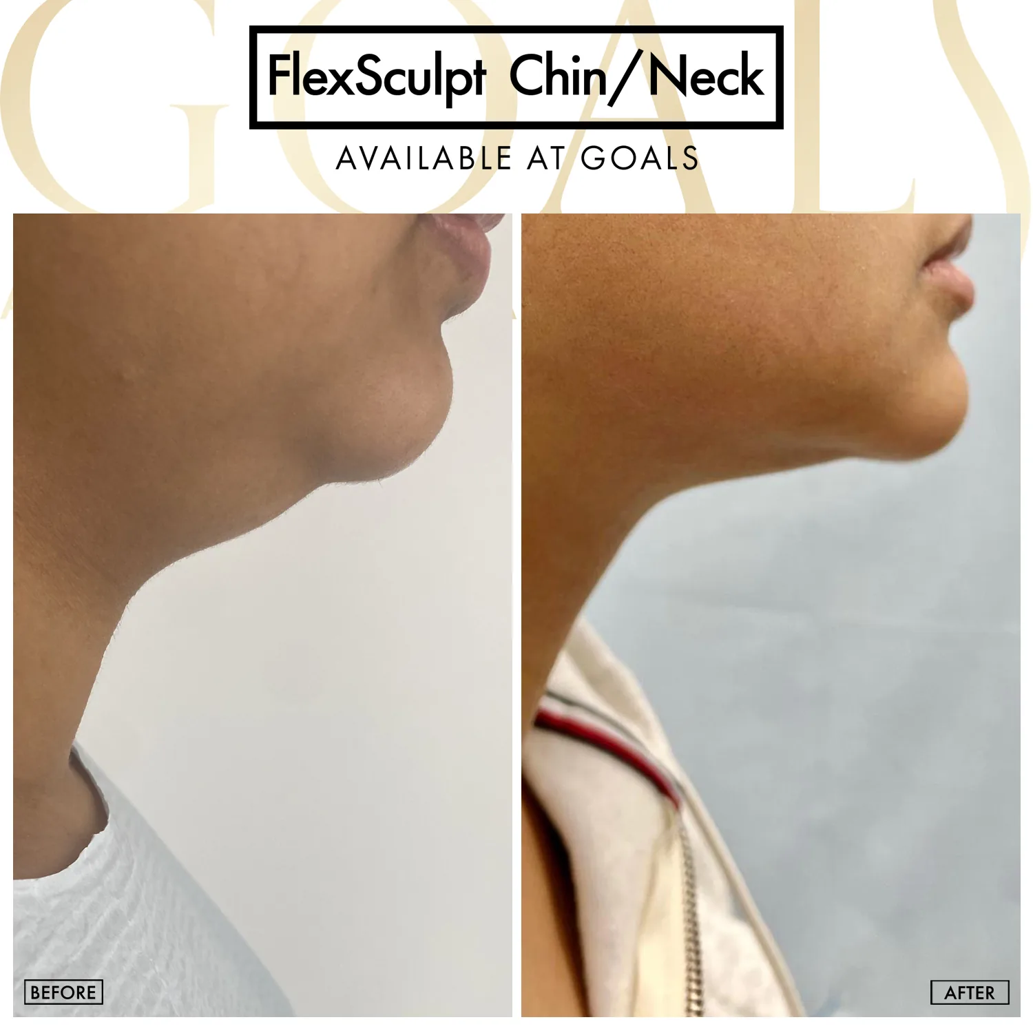 Before and after — Chin & Neck Contouring, patient 4
