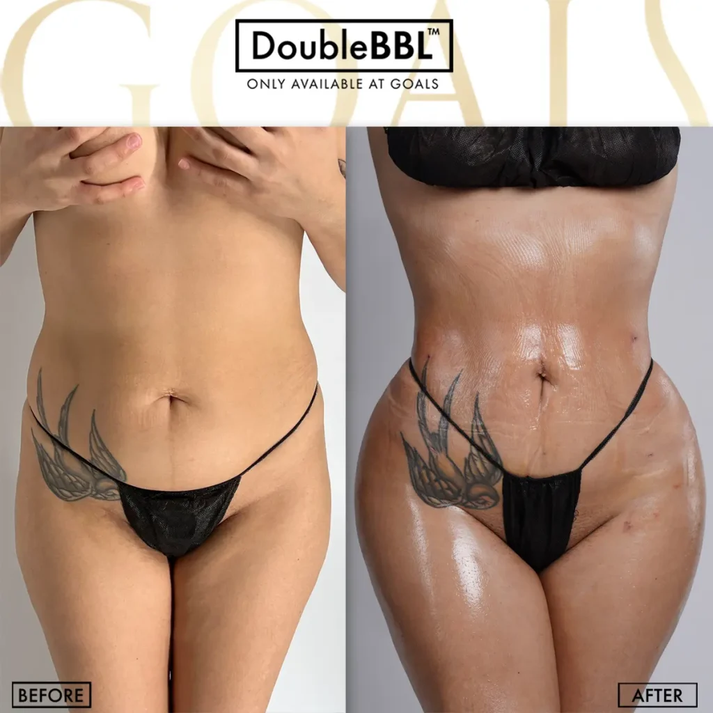 Antes y después de Brazilian Butt Lift, IMC inicial 25-30
