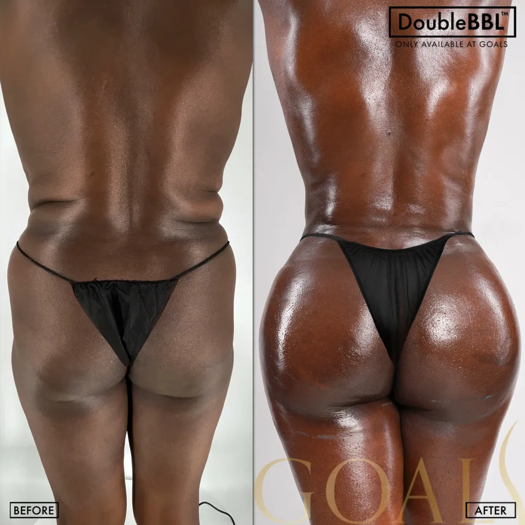 Antes y después de Brazilian Butt Lift, IMC inicial 20-25