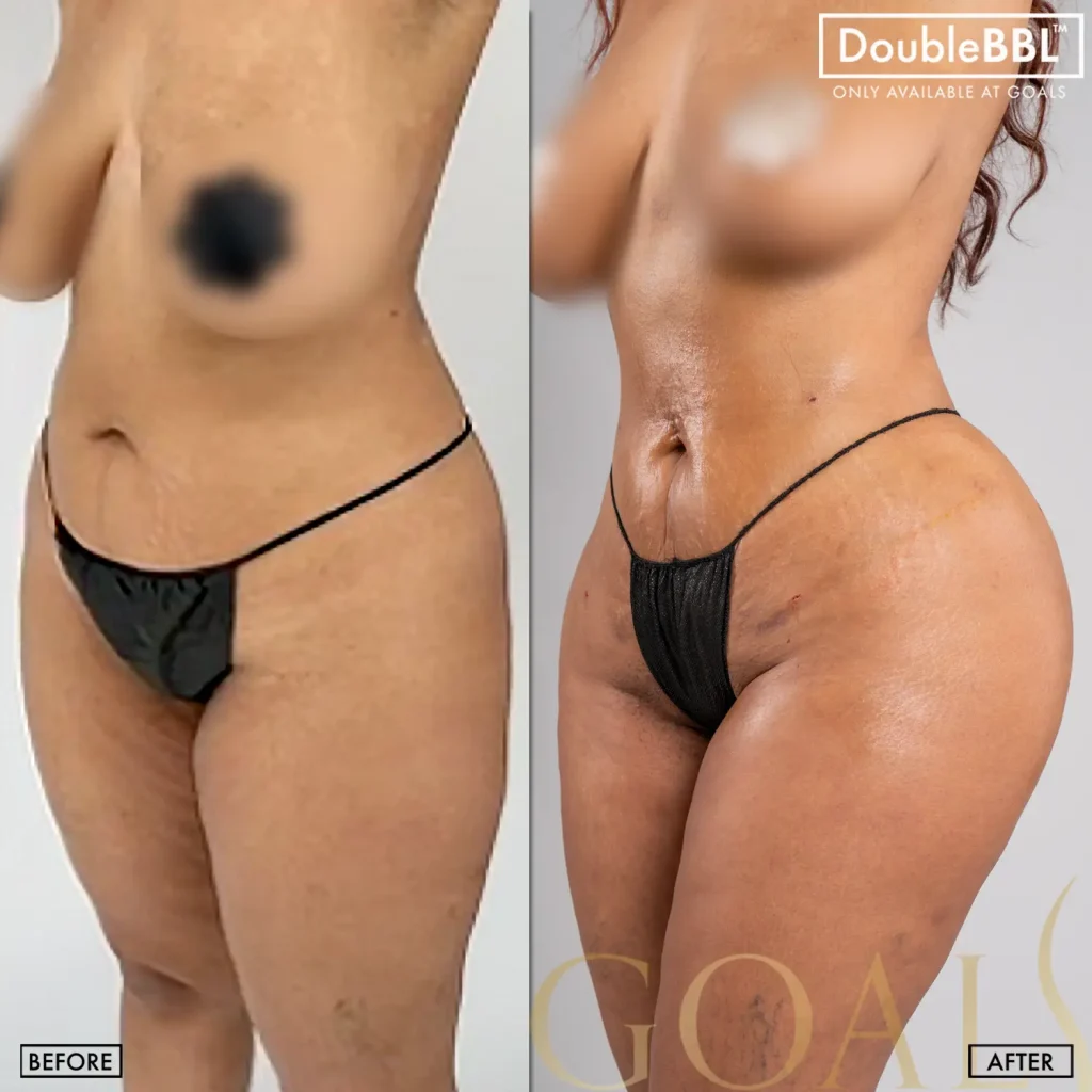 Antes y después de Brazilian Butt Lift, IMC inicial 25-30