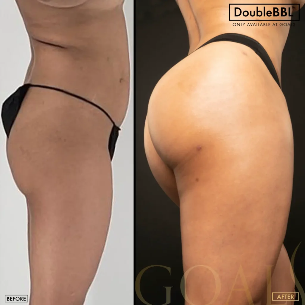 Antes y después de Brazilian Butt Lift, IMC inicial 25-30