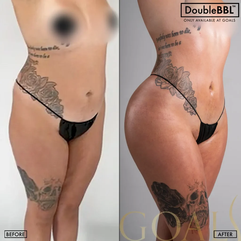 Antes y después de Brazilian Butt Lift, IMC inicial 30-35