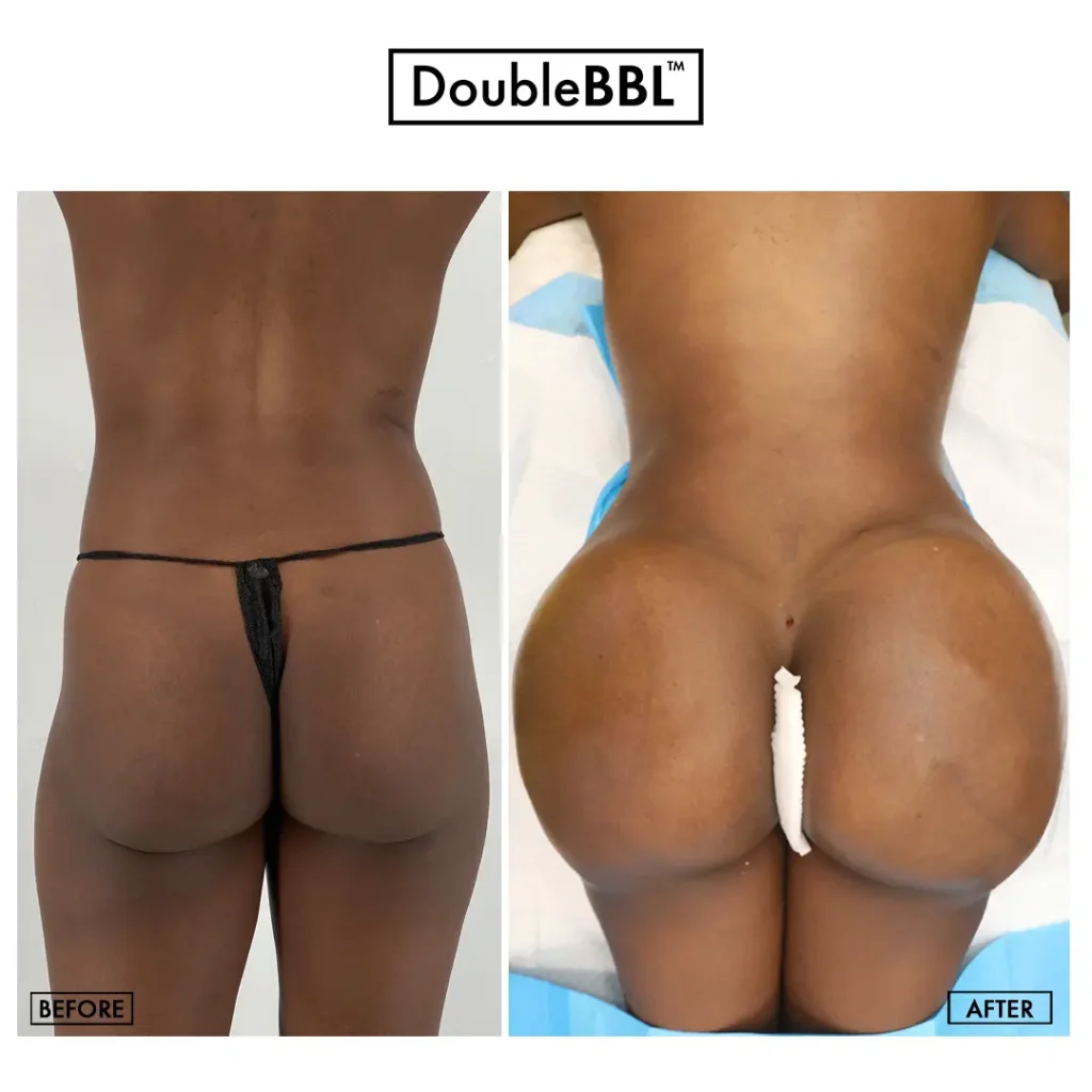 A Goals patient's brazilian butt lift result