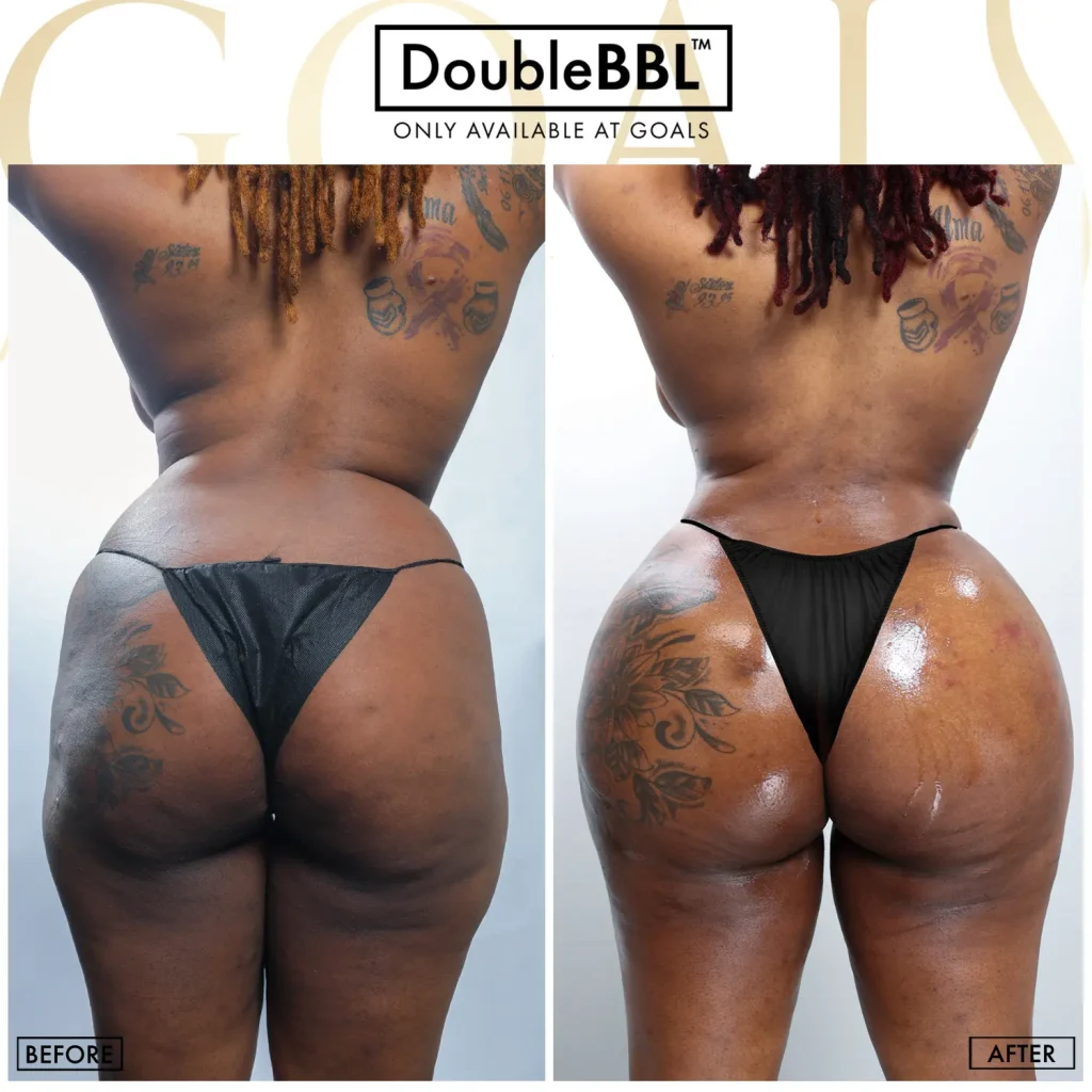 Antes y después de Brazilian Butt Lift, IMC inicial 30-35