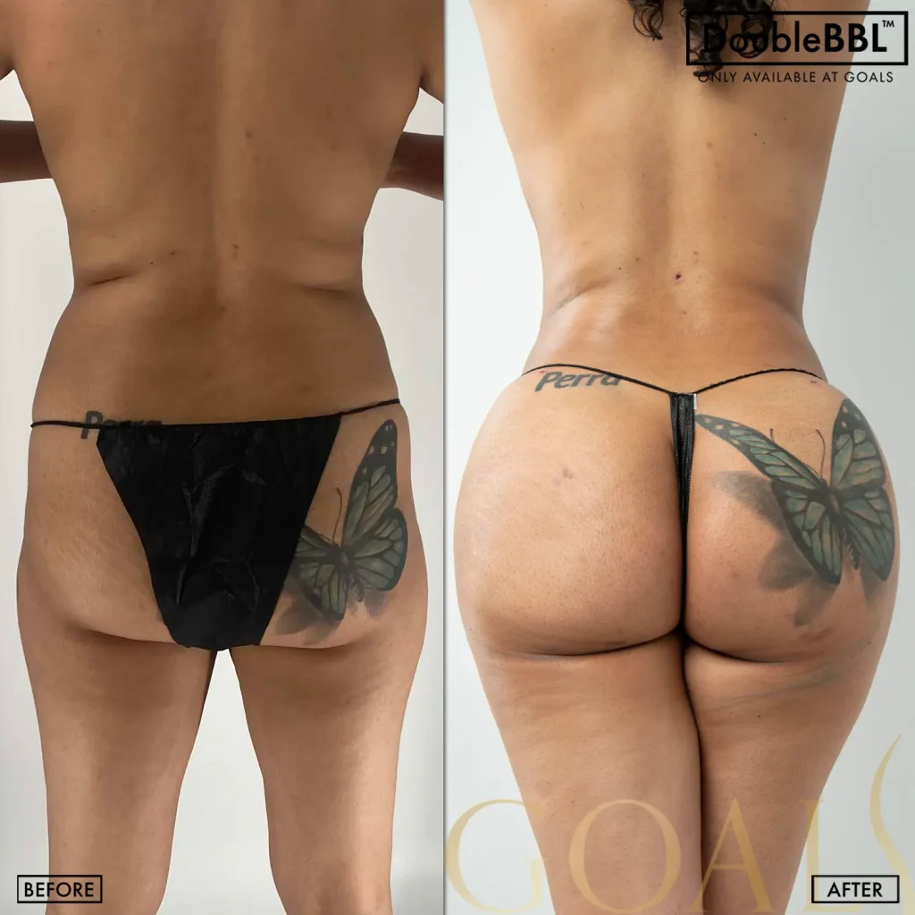 Antes y después de Brazilian Butt Lift, IMC inicial 25-30