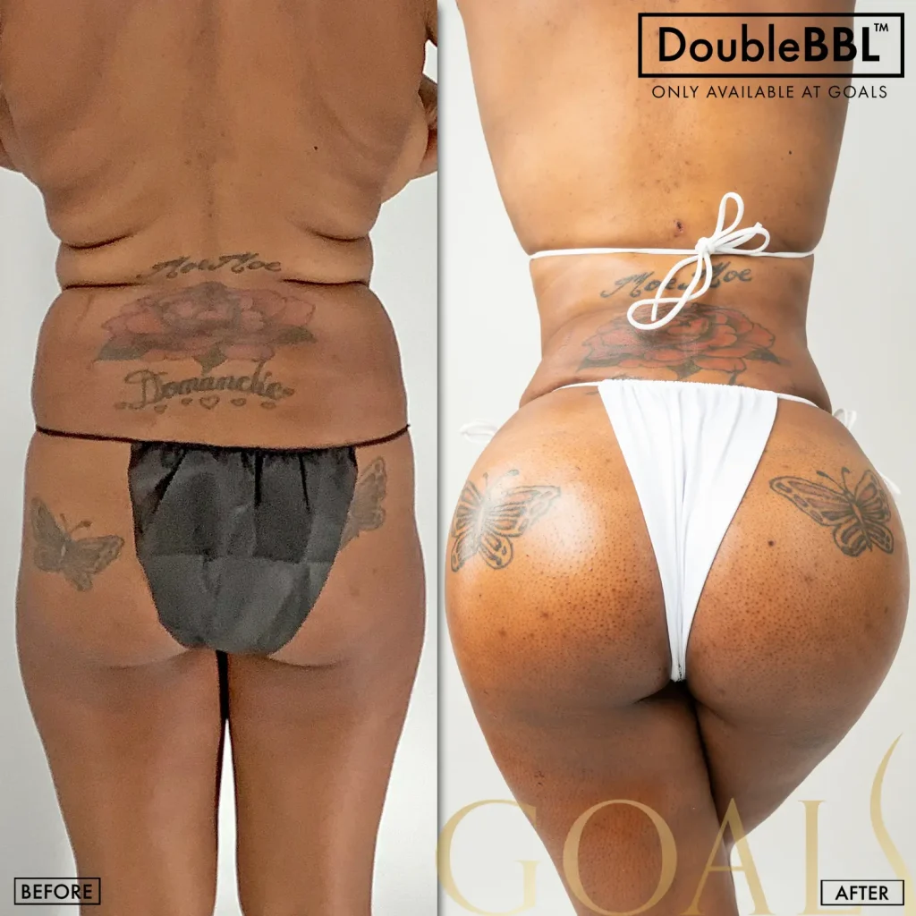 Antes y después de Brazilian Butt Lift, IMC inicial 25-30
