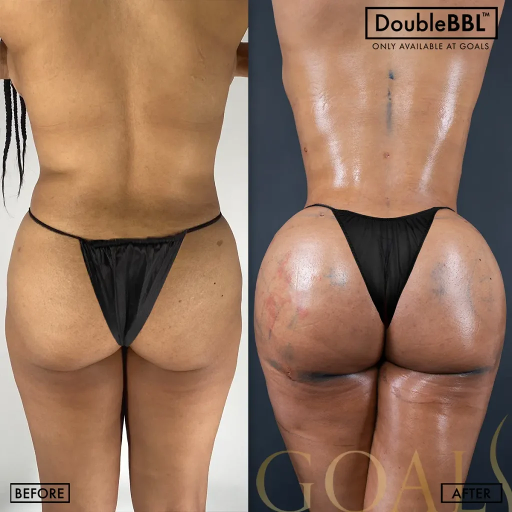 Antes y después de Brazilian Butt Lift, IMC inicial 25-30