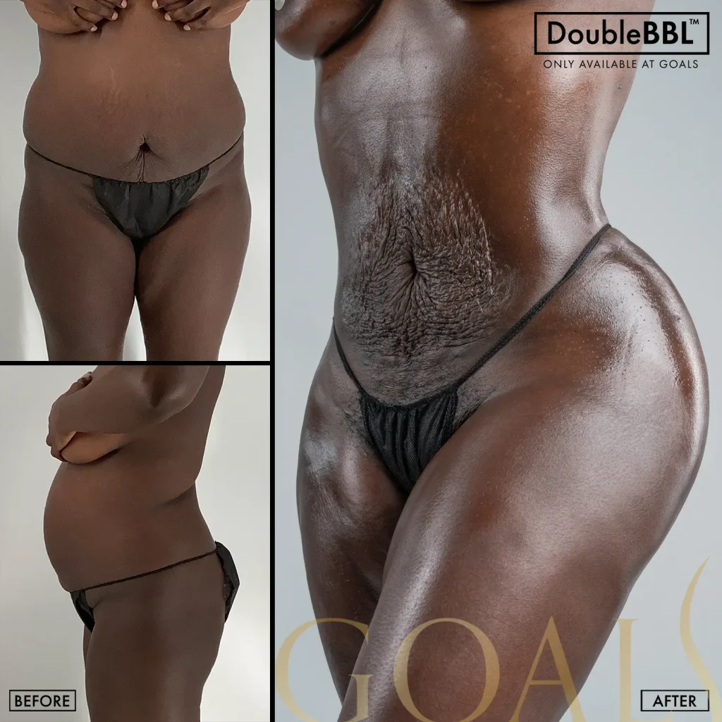 Before and after — Brazilian Butt Lift · Atlanta Walton St., patient 4
