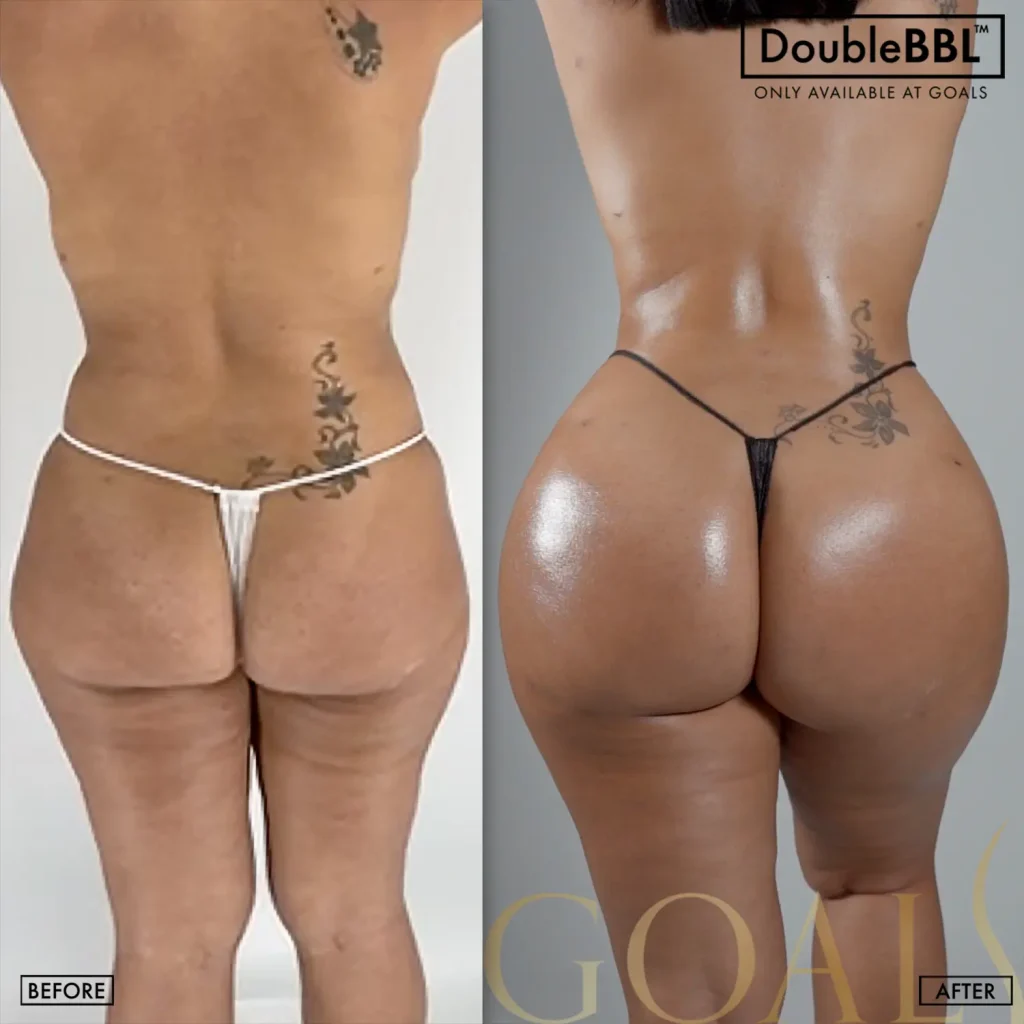 Before and after — Brazilian Butt Lift · Atlanta Walton St., patient 5