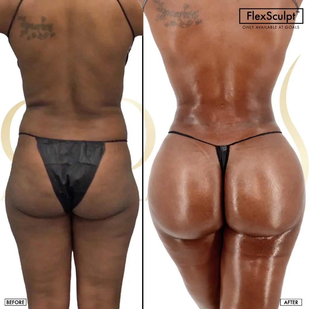 Before and after — Brazilian Butt Lift · Atlanta Tucker Rd., patient 5