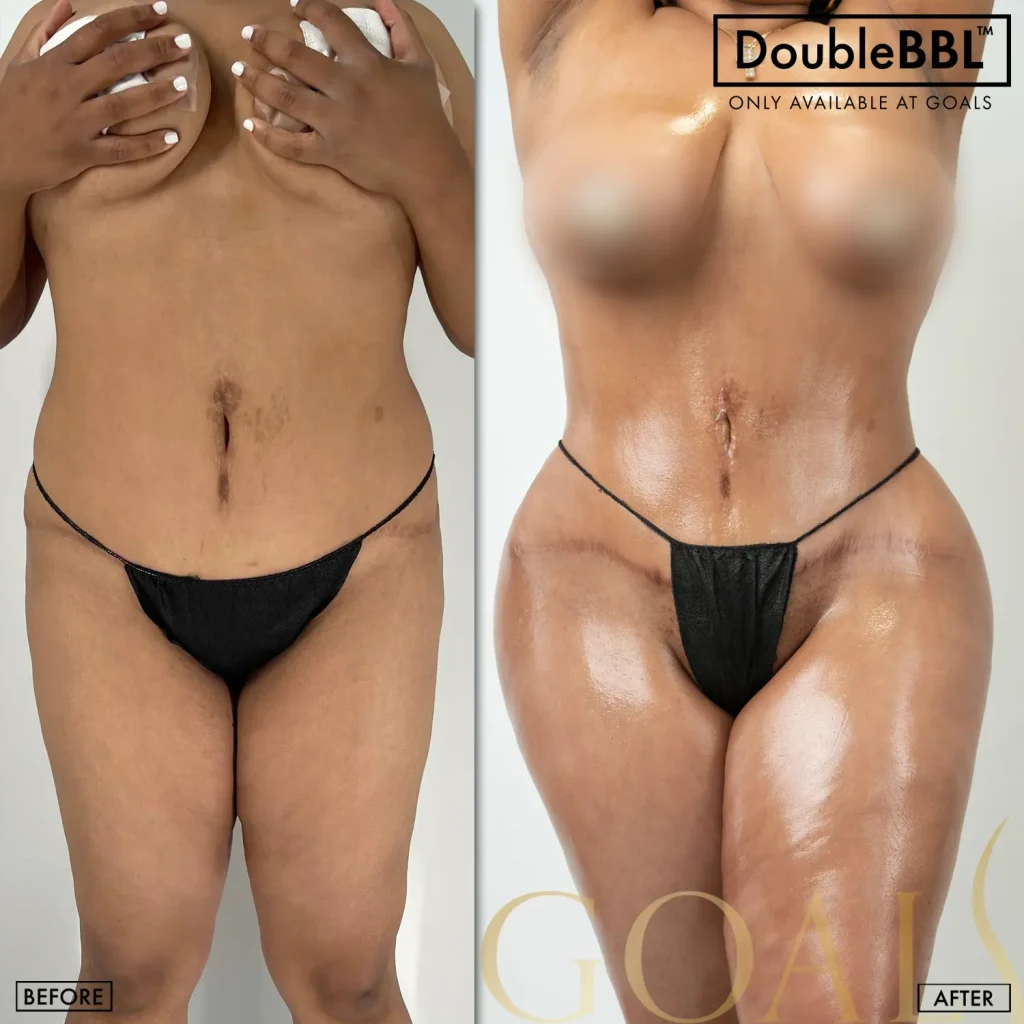 Brazilian Butt Lift — patient result