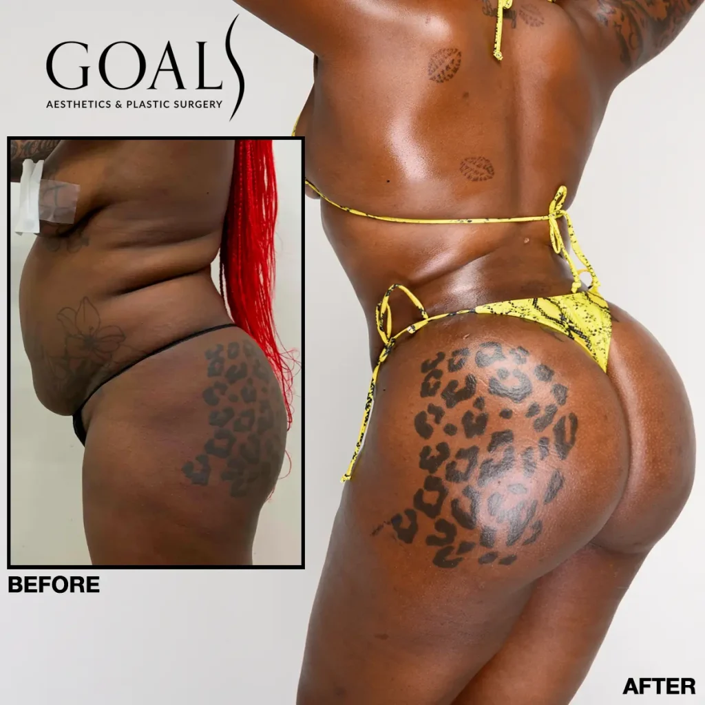 Before and after — Brazilian Butt Lift · Houston, patient 2