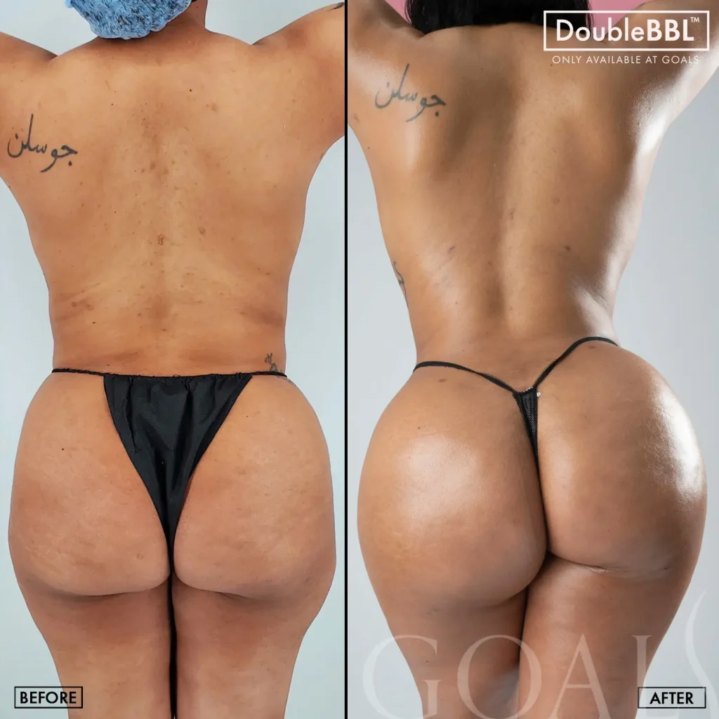 Before and after — Brazilian Butt Lift · Houston, patient 3