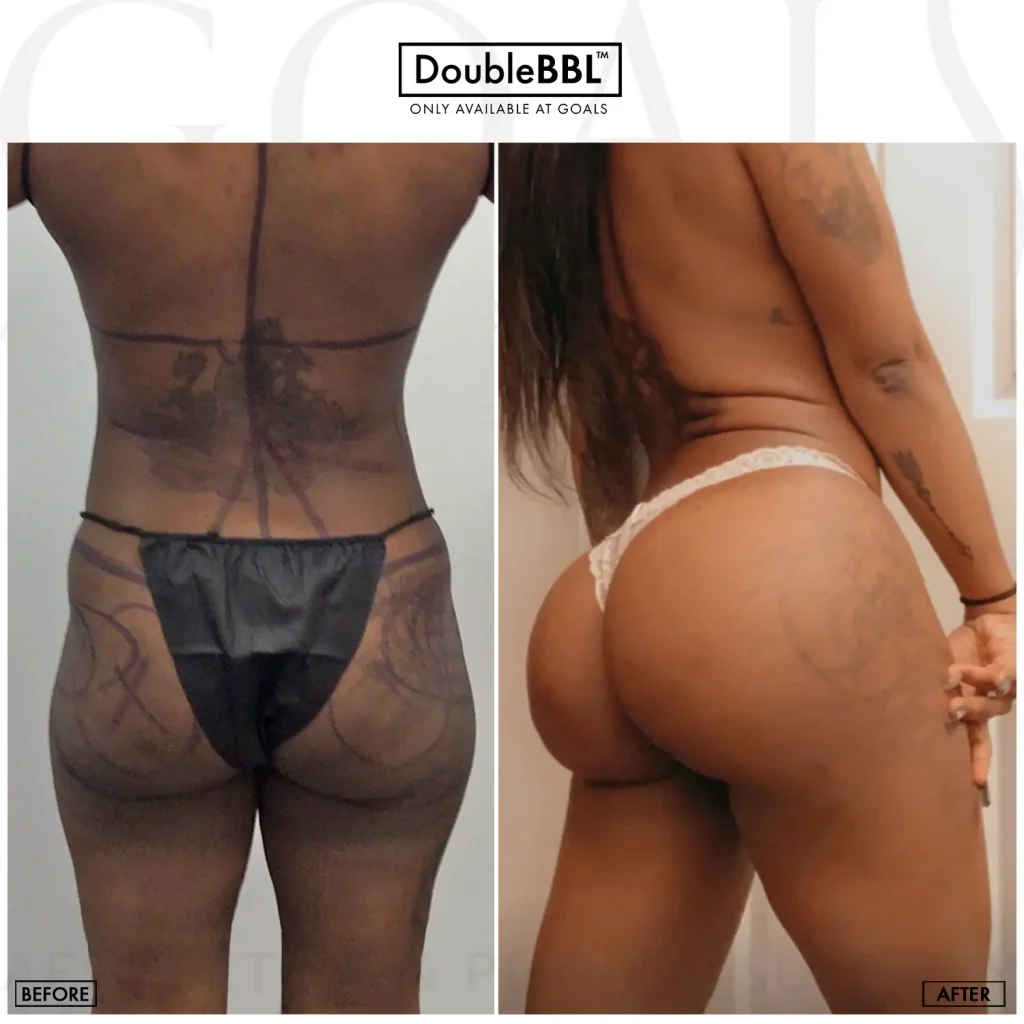 Before and after — Gaithersburg, patient 4
