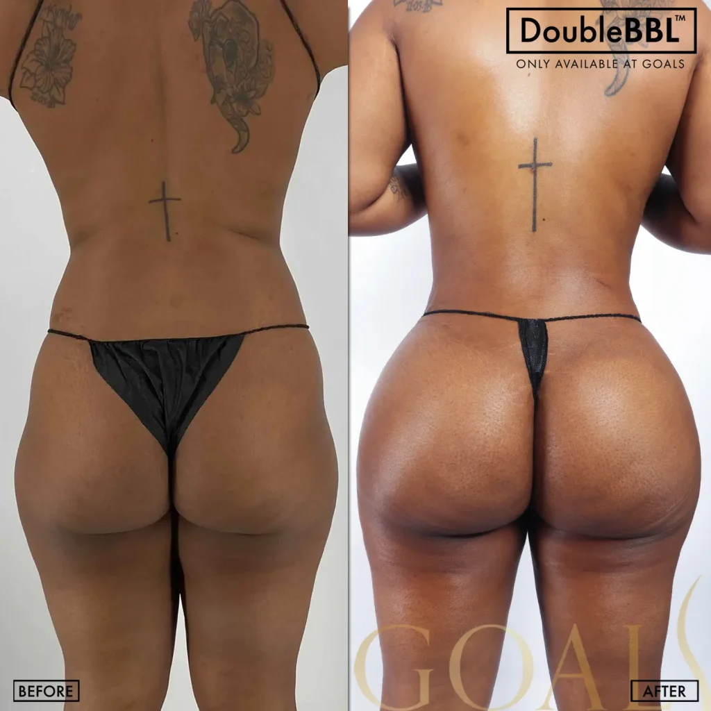 Before and after — Brooklyn, patient 2