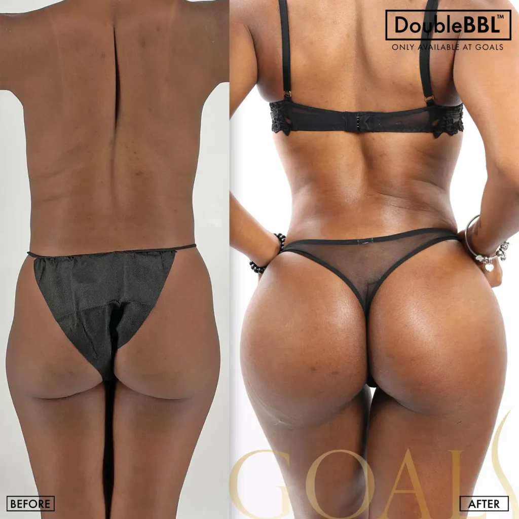Before and after — Brazilian Butt Lift, patient 1