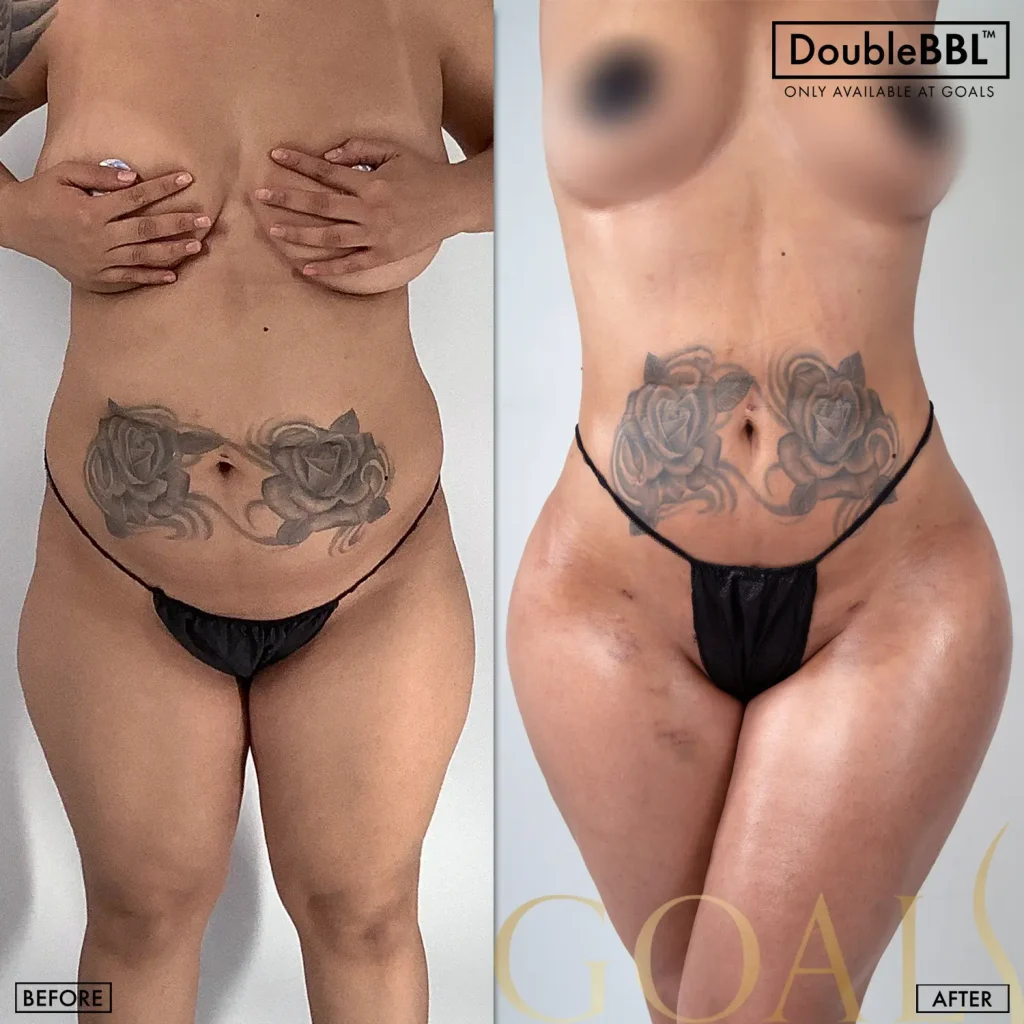 Before and after — Brazilian Butt Lift, patient 3