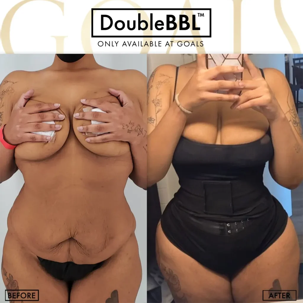 Before and after — Brazilian Butt Lift, patient 4