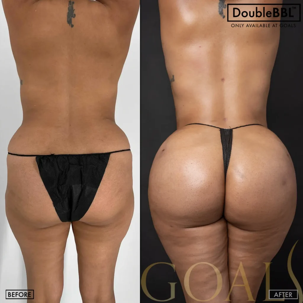 Before and after — Brazilian Butt Lift, patient 6