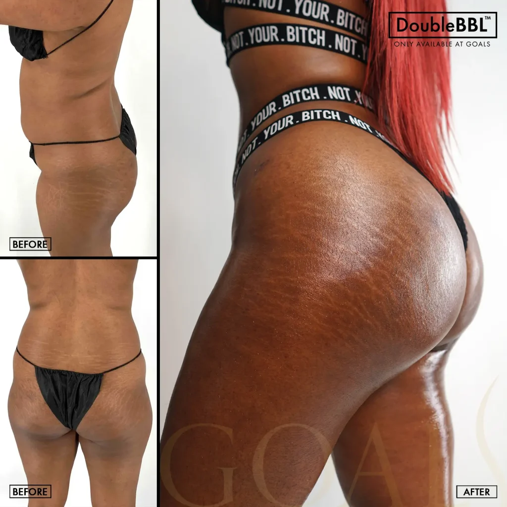 Before and after — Brazilian Butt Lift, patient 2