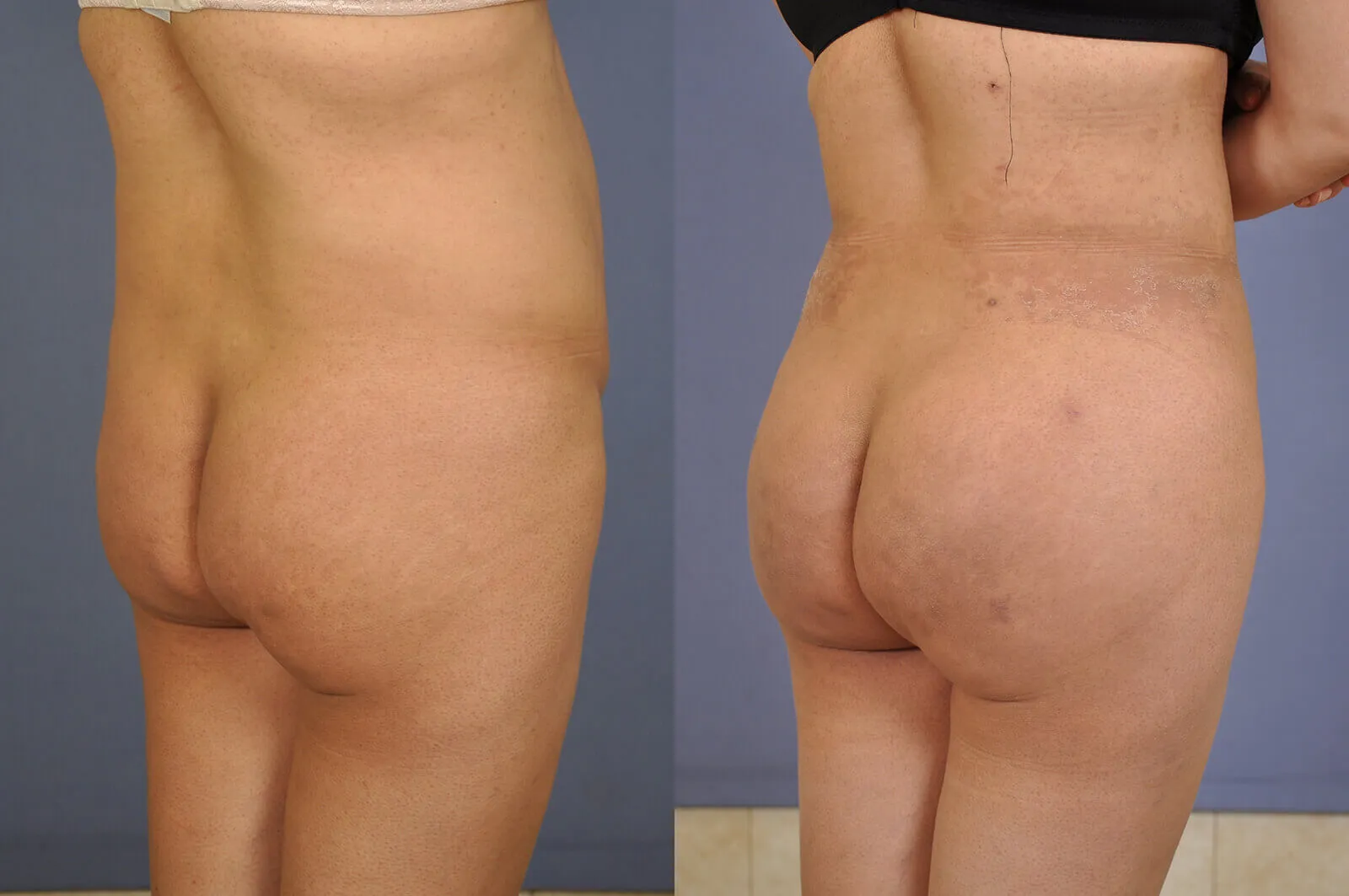 Before and after — Brazilian Butt Lift, patient 3